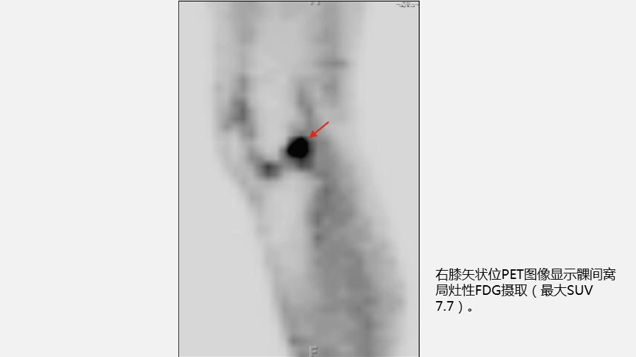 PET之膝关节骨性关节炎影像学病例ppt课件.pptx_第3页