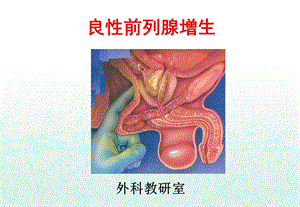 《良性前列腺增生》PPT课件.ppt