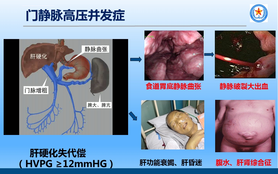 TIPS治疗肝硬化门脉高压ppt课件.ppt_第2页