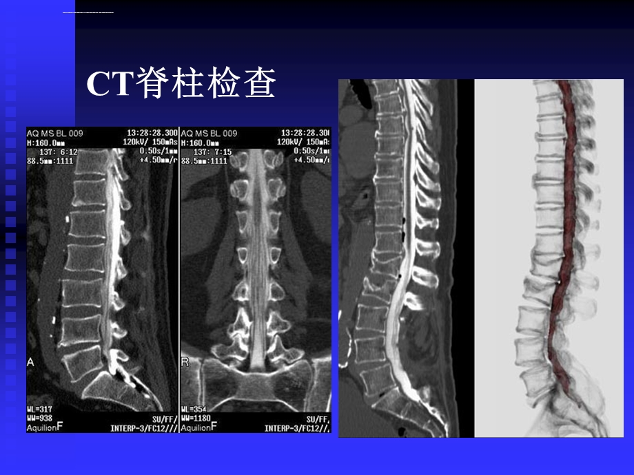 《脊柱肿瘤》ppt课件.ppt_第3页