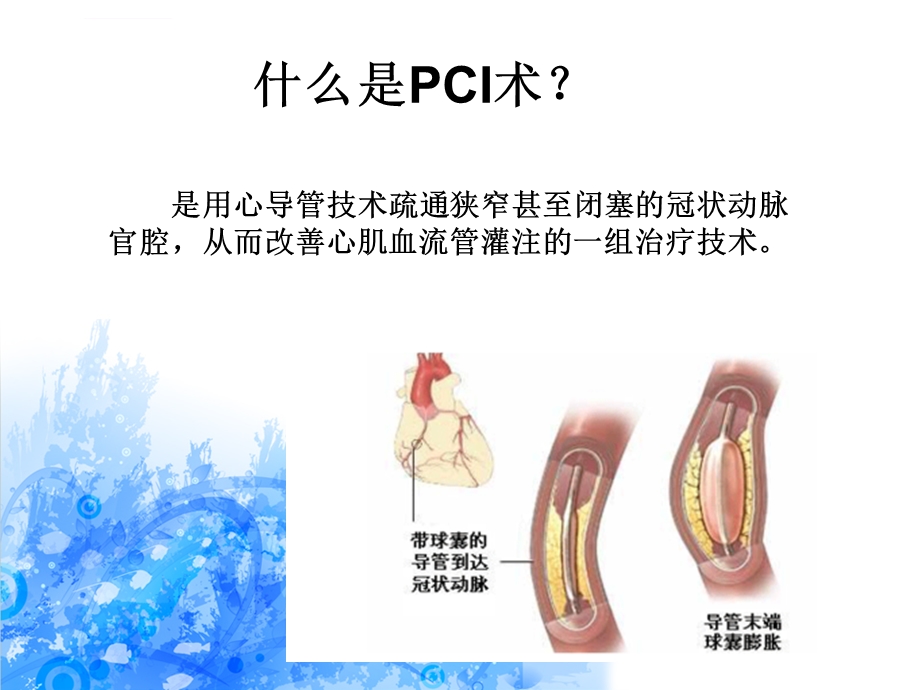 PCI术前术后的护理ppt课件.ppt_第2页