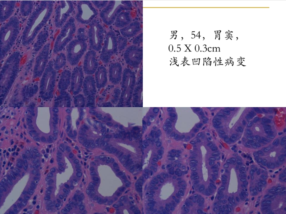 上消化道早癌病理诊断标准 东西方的碰撞ppt课件.pptx_第3页