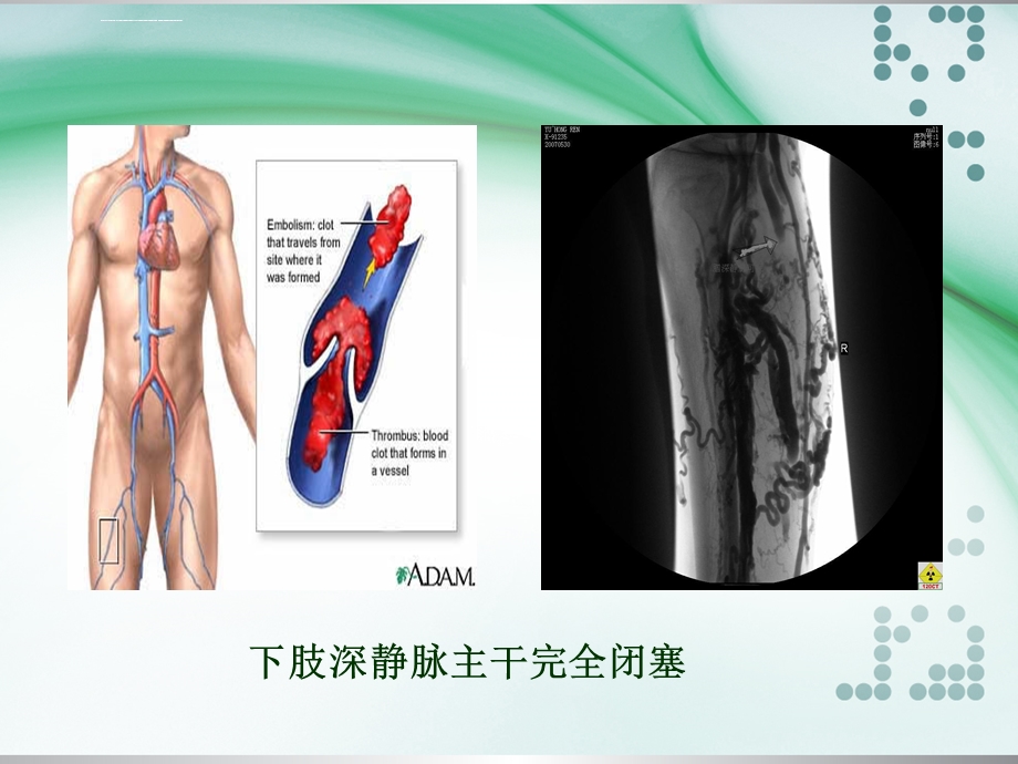 下肢深静脉血栓的护理ppt课件.ppt_第3页