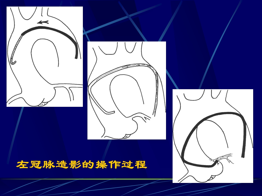 冠脉造影术简装板 绝好课件.ppt_第2页