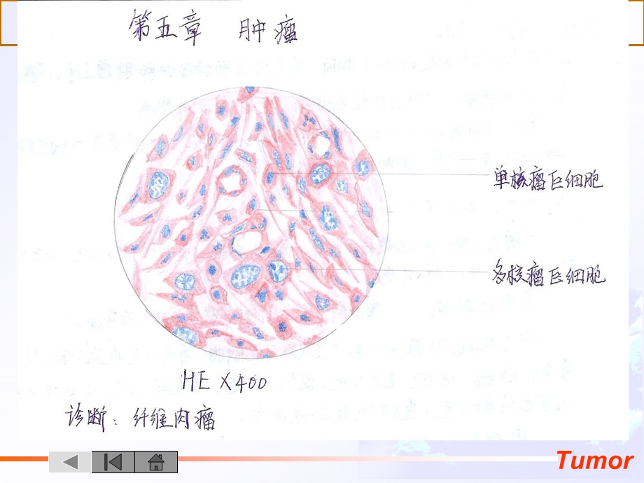 病理学之肿瘤课件.ppt_第2页