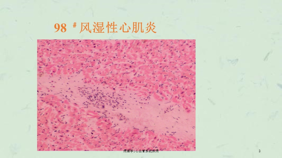 病理学1心血管系统疾病课件.ppt_第3页