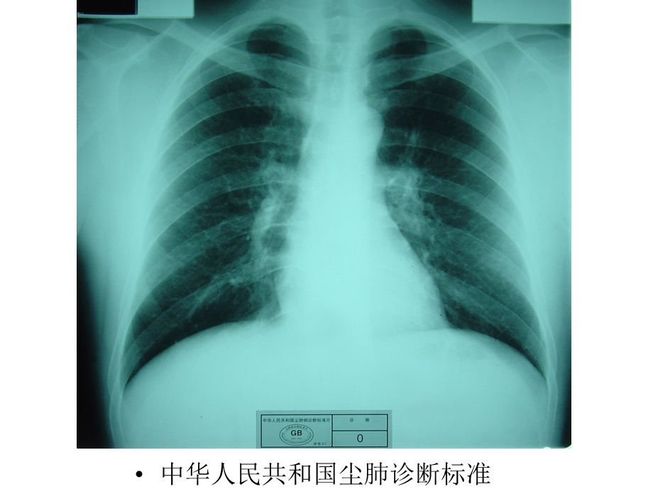 尘肺标准片课件.ppt_第2页