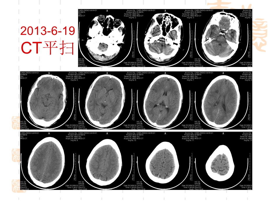 多发性急性脑梗塞病例讨论课件.ppt_第3页