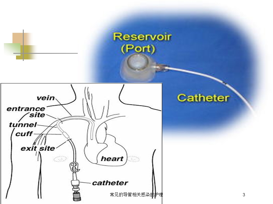 常见的导管相关感染的护理培训课件.ppt_第3页