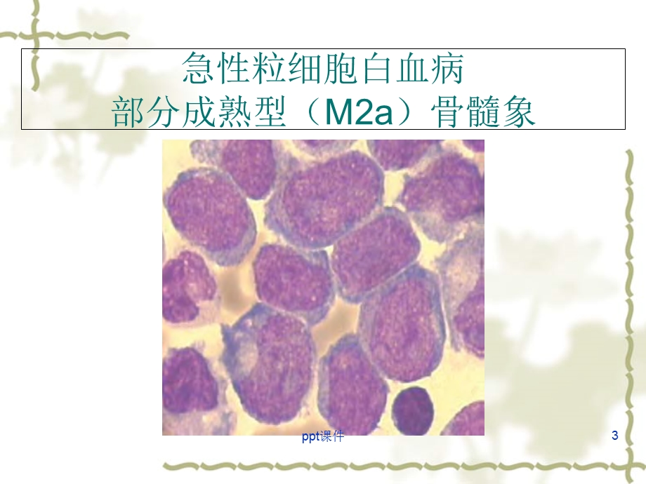 急性白血病图谱课件.ppt_第3页