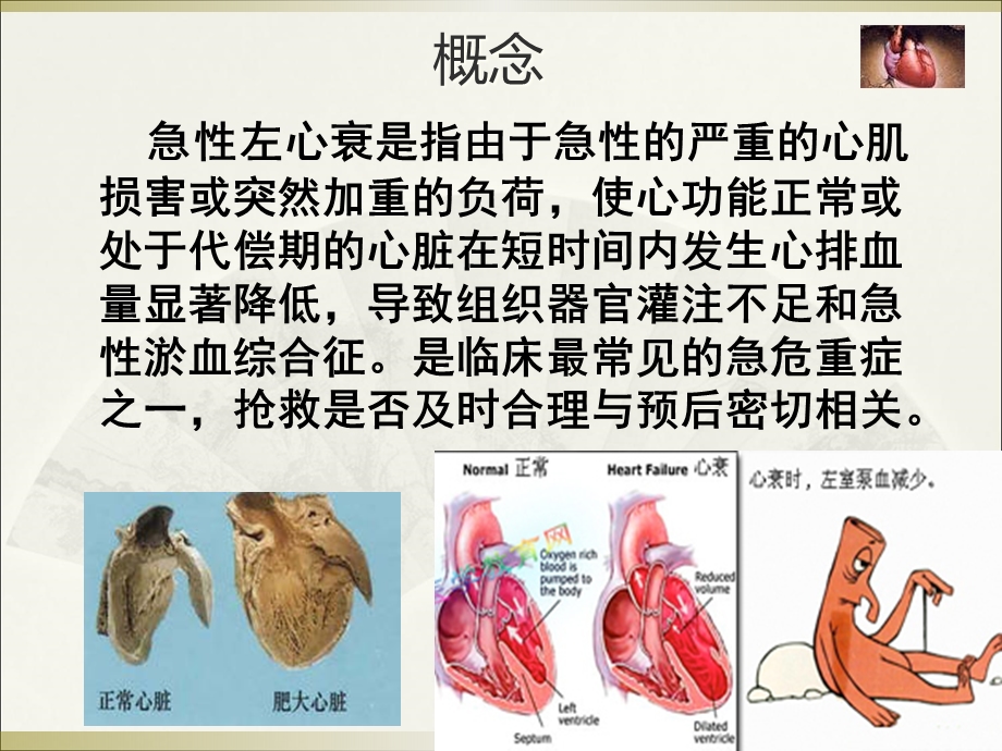 急性左心衰的急救护理1教材课件.ppt_第2页