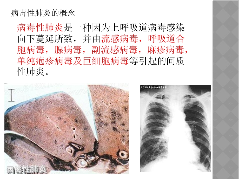 病毒性肺炎25494课件.ppt_第2页