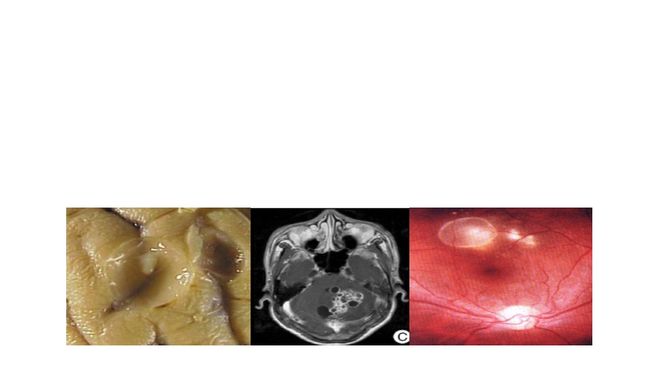 神经系统囊虫病的诊断和治疗课件.ppt_第1页