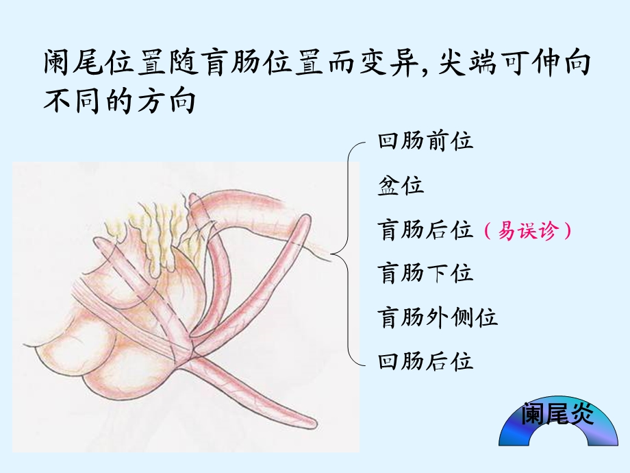 急性阑尾炎患者的护理课件.pptx_第3页