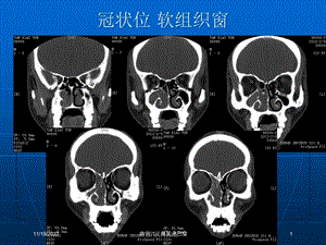 病例讨论鼻窦淋巴瘤培训课件.ppt