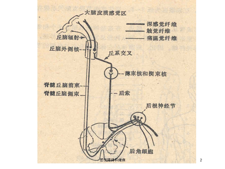 感觉障碍和瘫痪培训课件.ppt_第2页