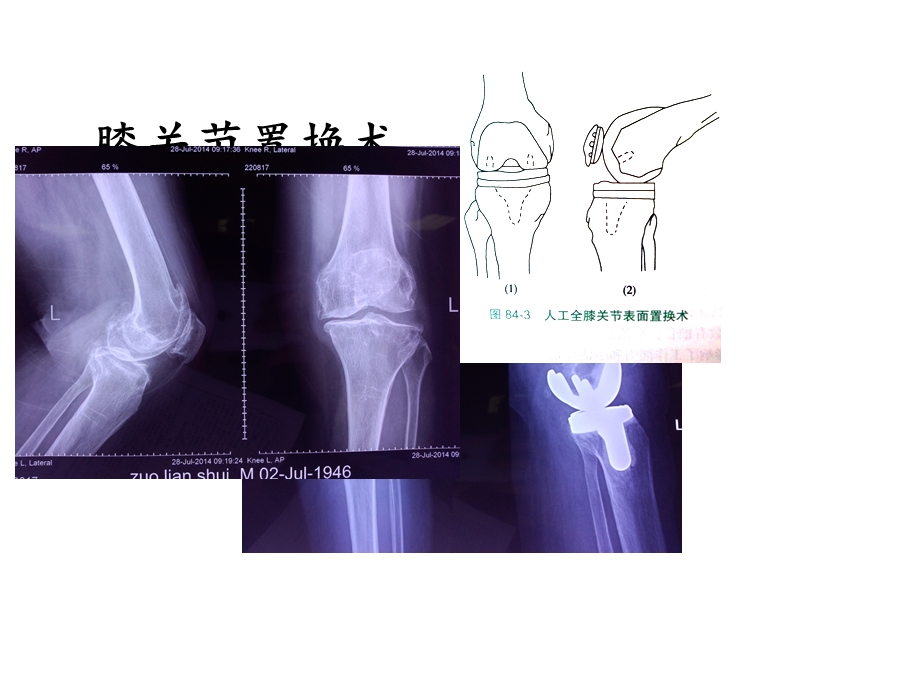 髋、膝关节置换适应症和并发症课件.ppt_第2页