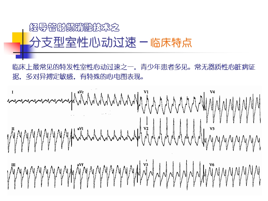 分支型室速的标测与消融ppt课件.ppt_第2页