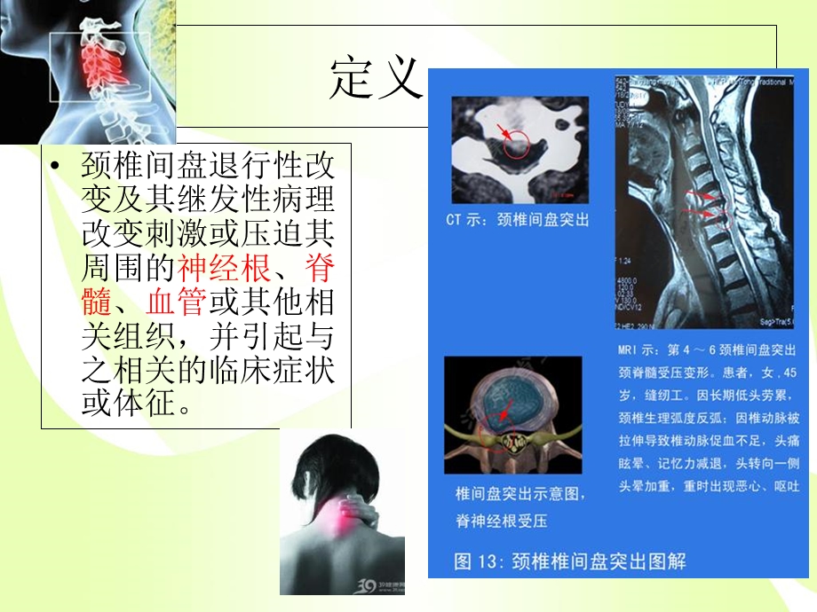 颈椎病健康教育课件.ppt_第2页