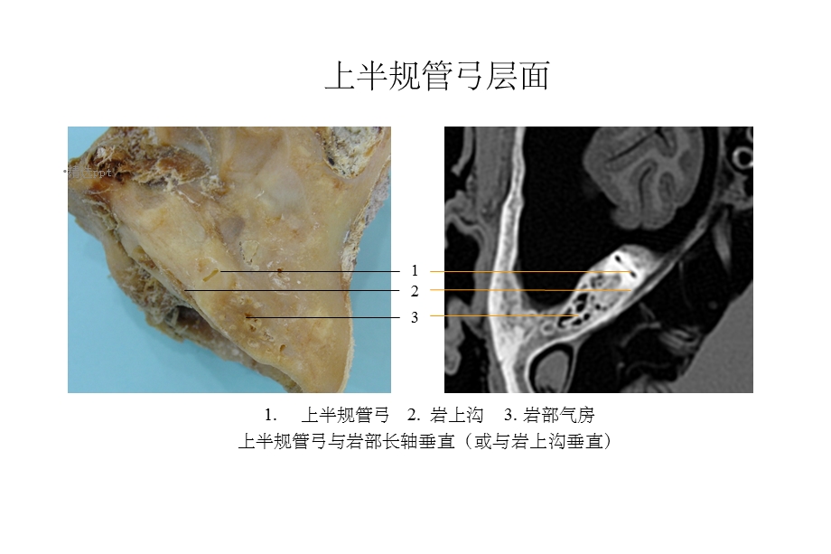 颞骨断层解剖与CT水平位课件.ppt_第3页