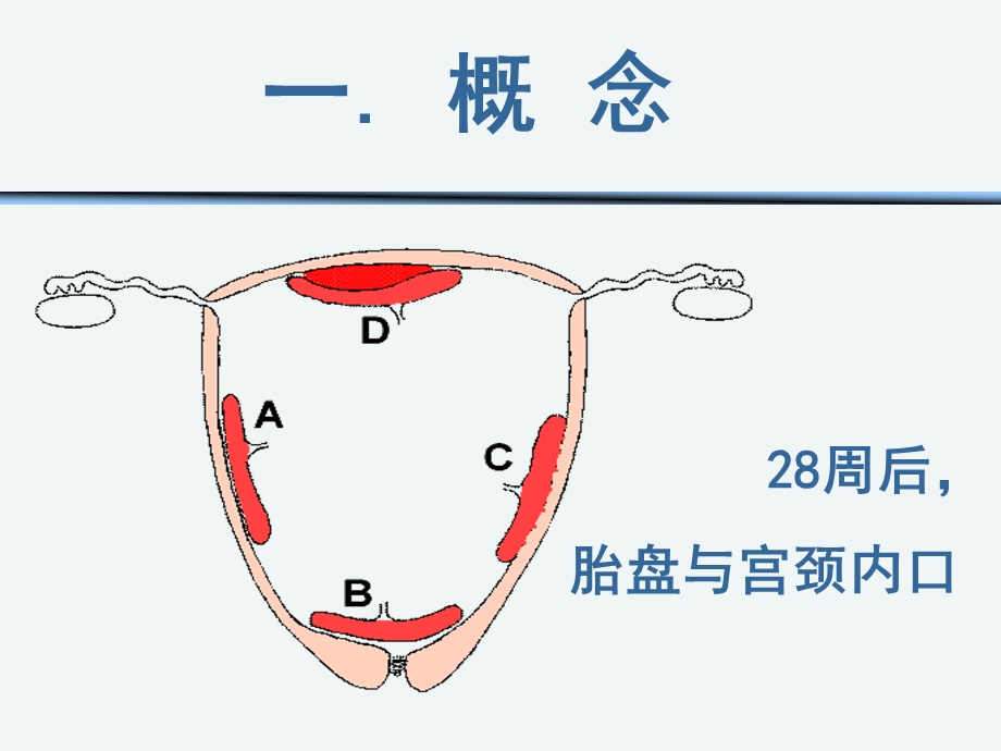 前置胎盘护理ppt课件.ppt_第3页