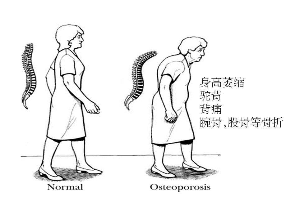 骨骼及眼睛保健课件.ppt_第3页