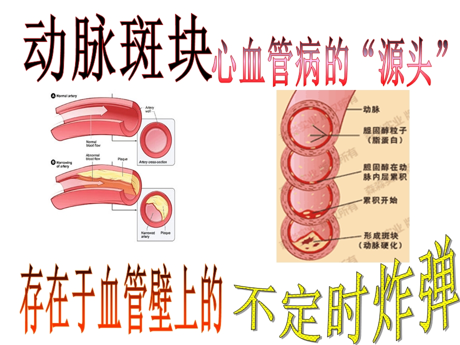 颈动脉斑块专题课件.ppt_第1页