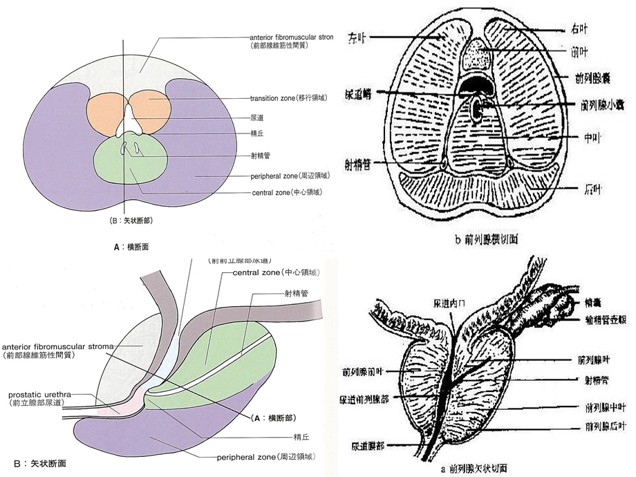 前列腺癌的穿刺活检ppt课件.ppt_第3页