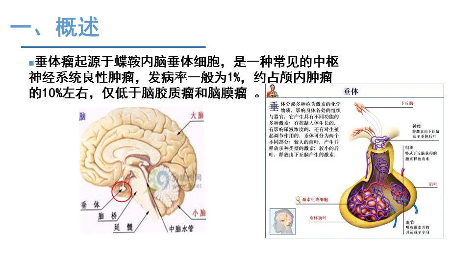 垂体瘤的护理ppt课件.pptx_第3页