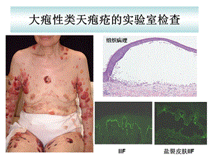 大疱性类天疱疮的试验室检查ppt课件.ppt