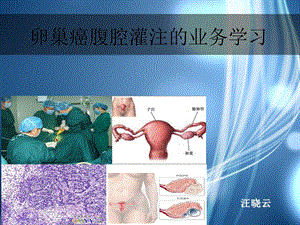 卵巢癌腹腔灌注化疗护理ppt课件.ppt