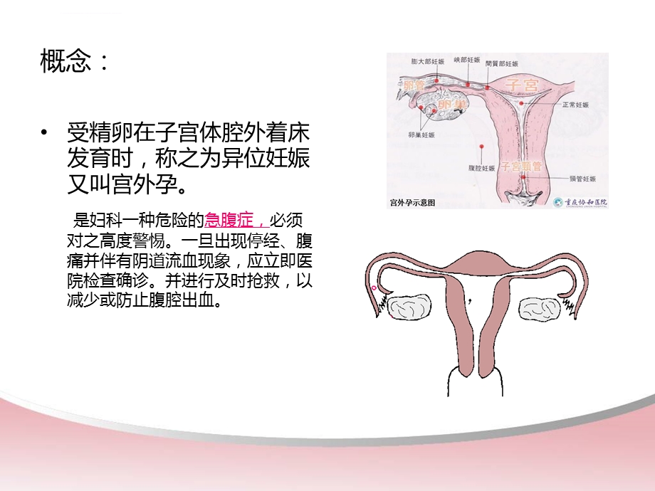 宫外孕腹腔镜术前术后的护理ppt课件.ppt_第2页