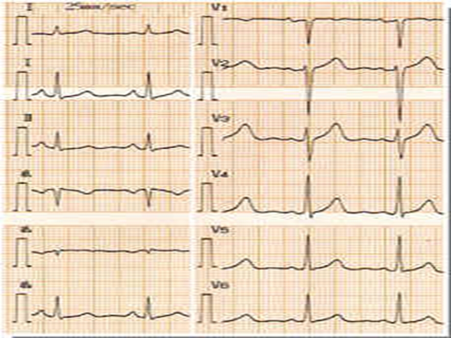 心电图图谱分析ppt课件.pptx_第2页