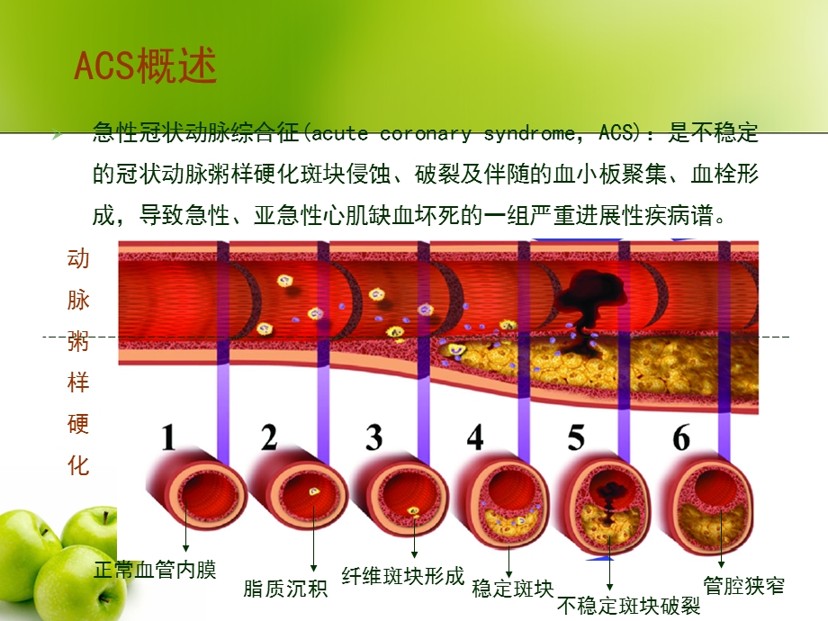 急性冠脉综合征的护理ppt课件.ppt_第2页