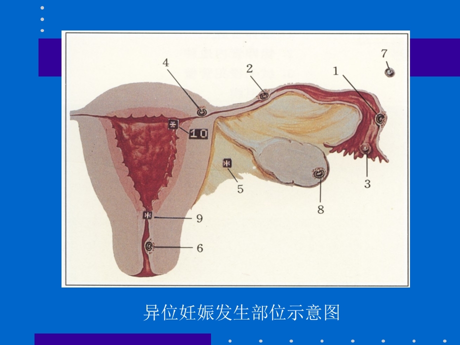 异位妊娠的超声诊断ppt课件.ppt_第3页