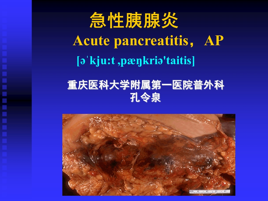 急性胰腺炎优秀ppt课件.ppt_第1页