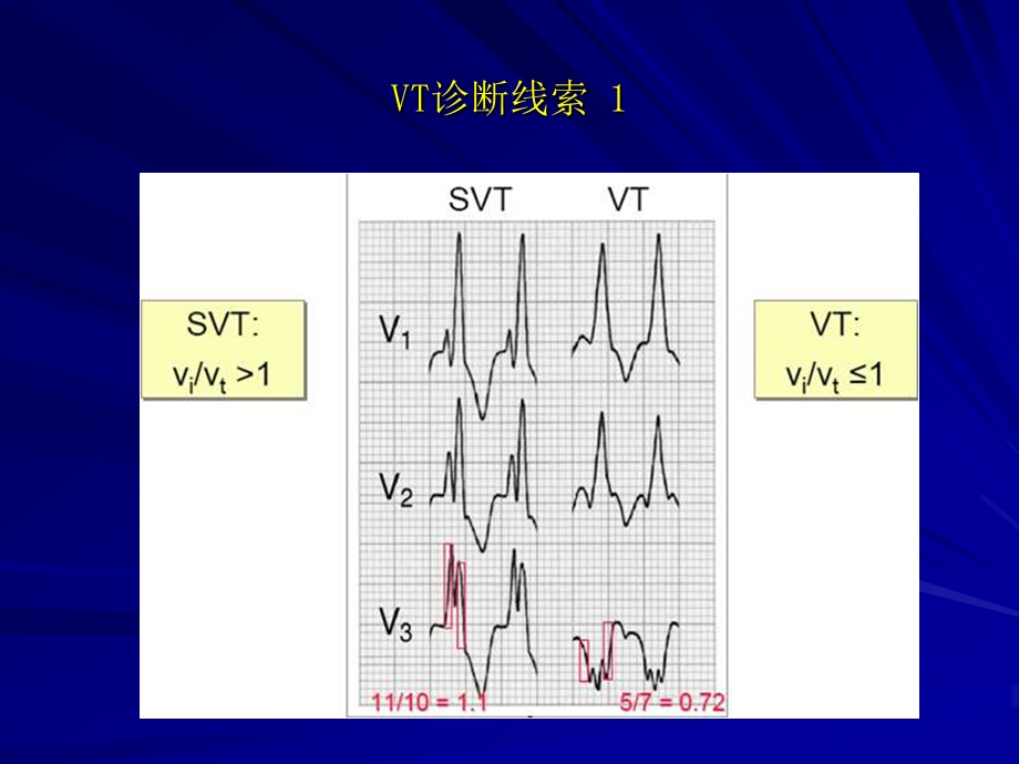 室速诊断与射频消融治疗ppt课件.ppt_第3页