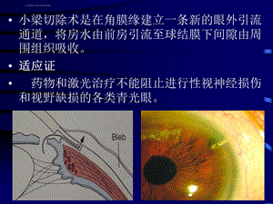 小梁切除术ppt课件.ppt