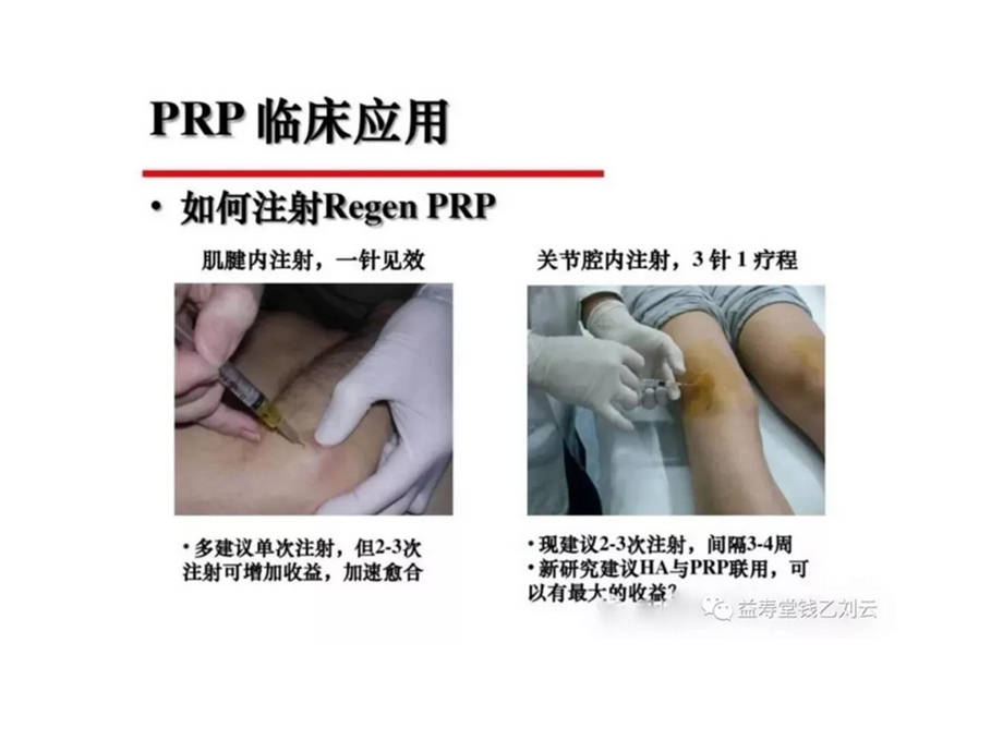 富血小板血浆(PRP)在骨病疼痛和创面的临床应用ppt课件.ppt_第1页