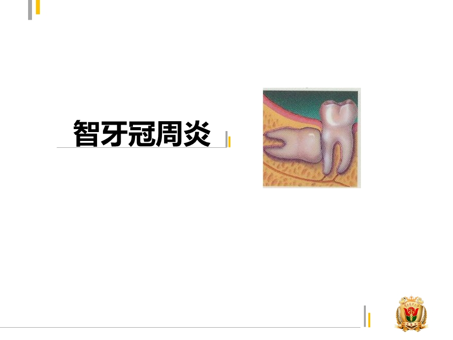 智牙冠周炎ppt课件.pptx_第1页