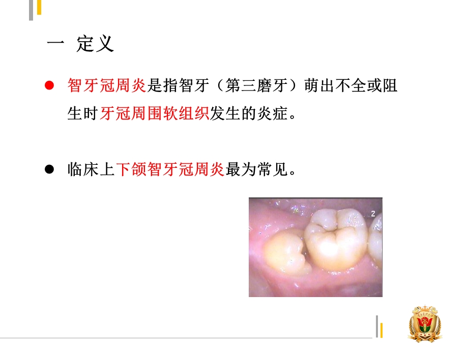 智牙冠周炎ppt课件.pptx_第2页