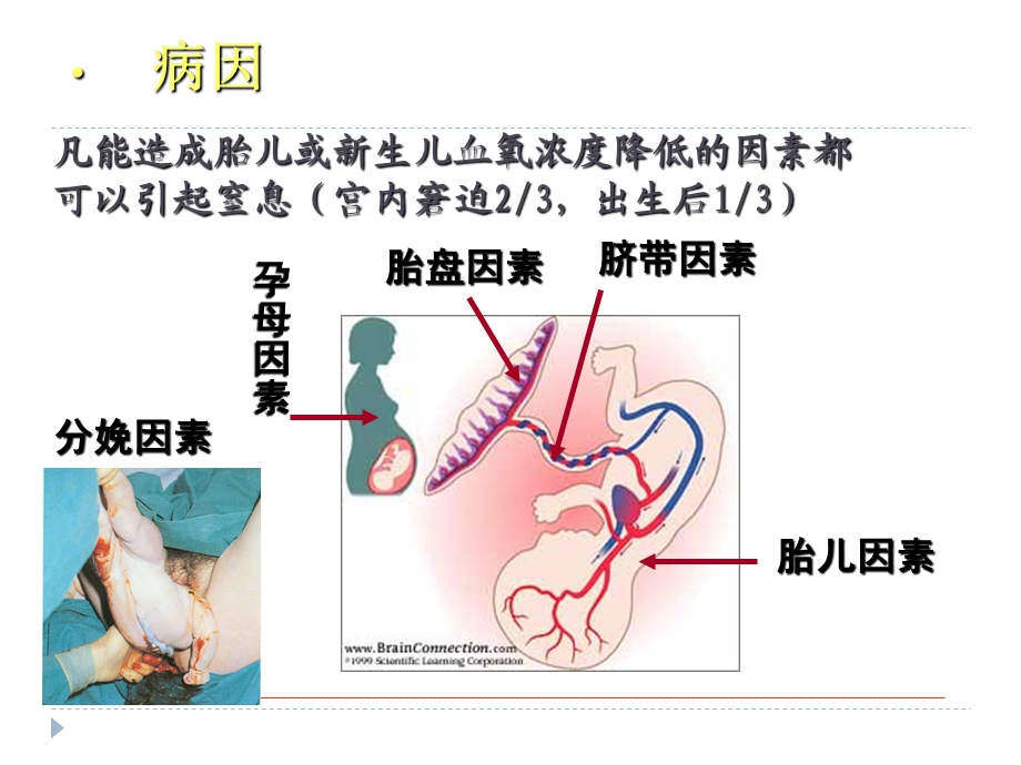 新生儿窒息ppt课件.pptx_第3页