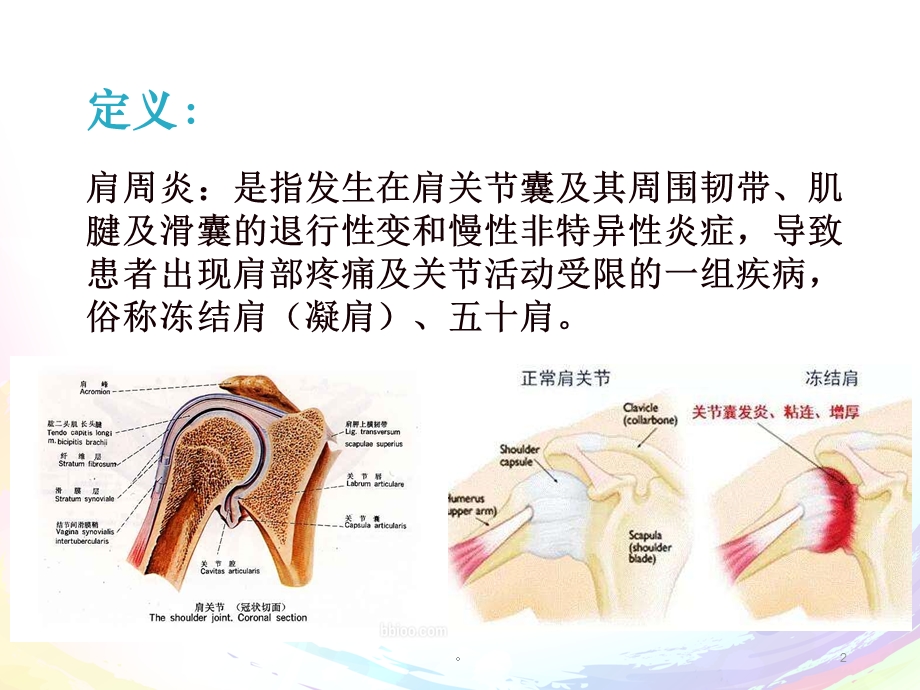 新版肩周炎的治疗及护理培训ppt课件.ppt_第2页