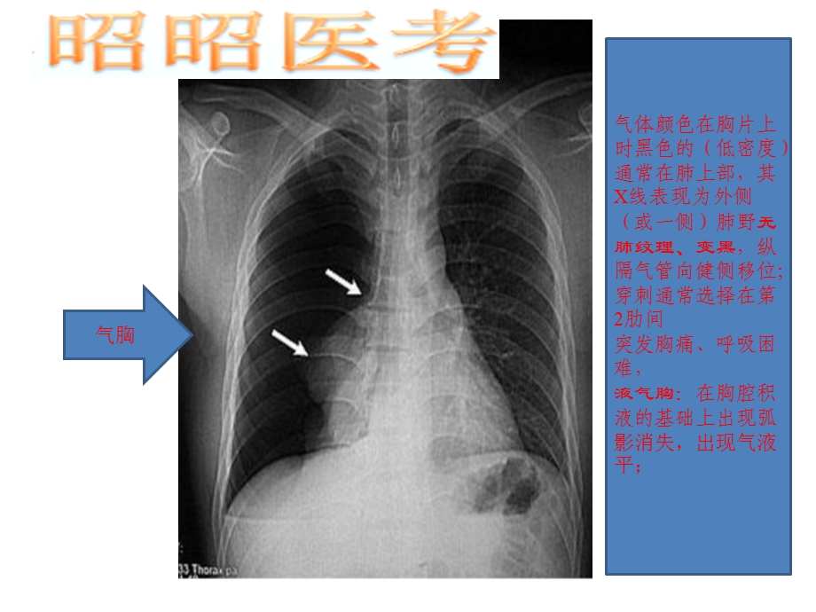 昭昭医考影像学考试图ppt课件.pptx_第3页