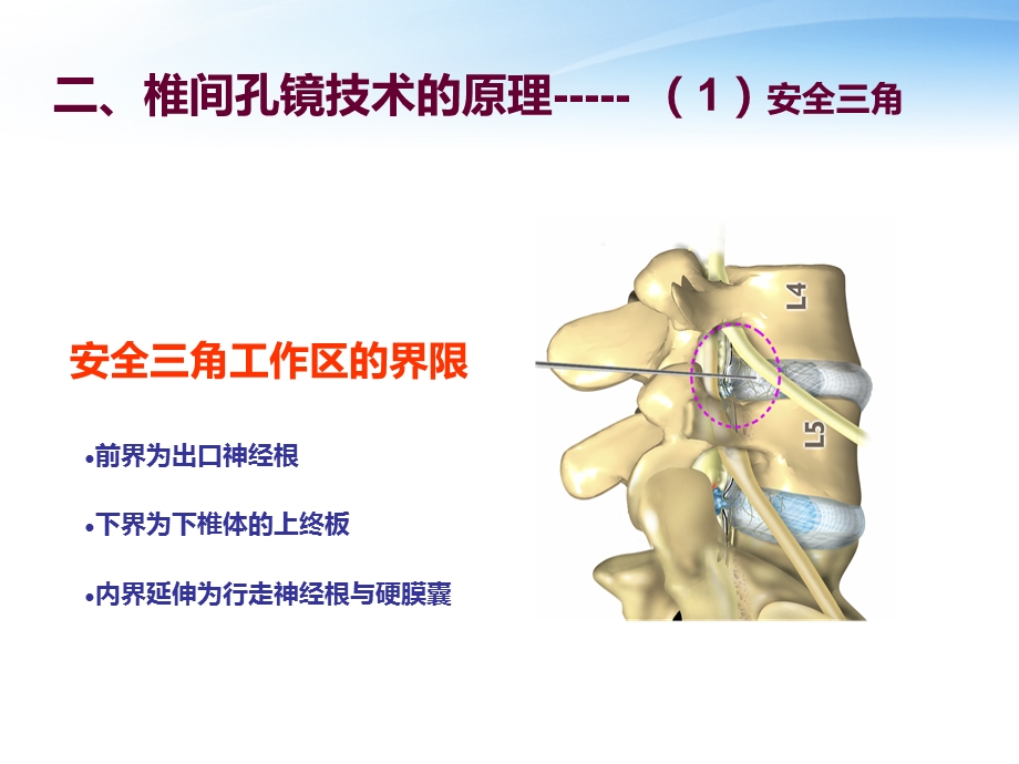 椎间孔镜技术介绍ppt课件.ppt_第3页