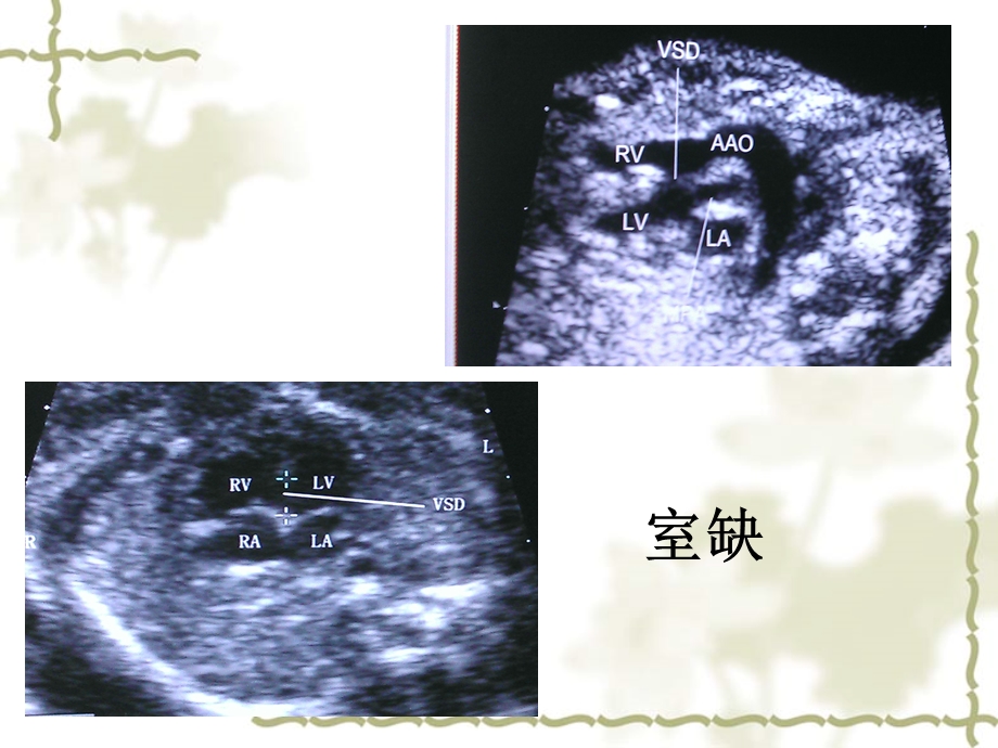 胎儿心脏畸形超声表现ppt课件.ppt_第3页