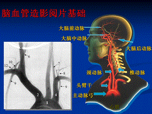 脑血管造影阅片ppt课件.ppt