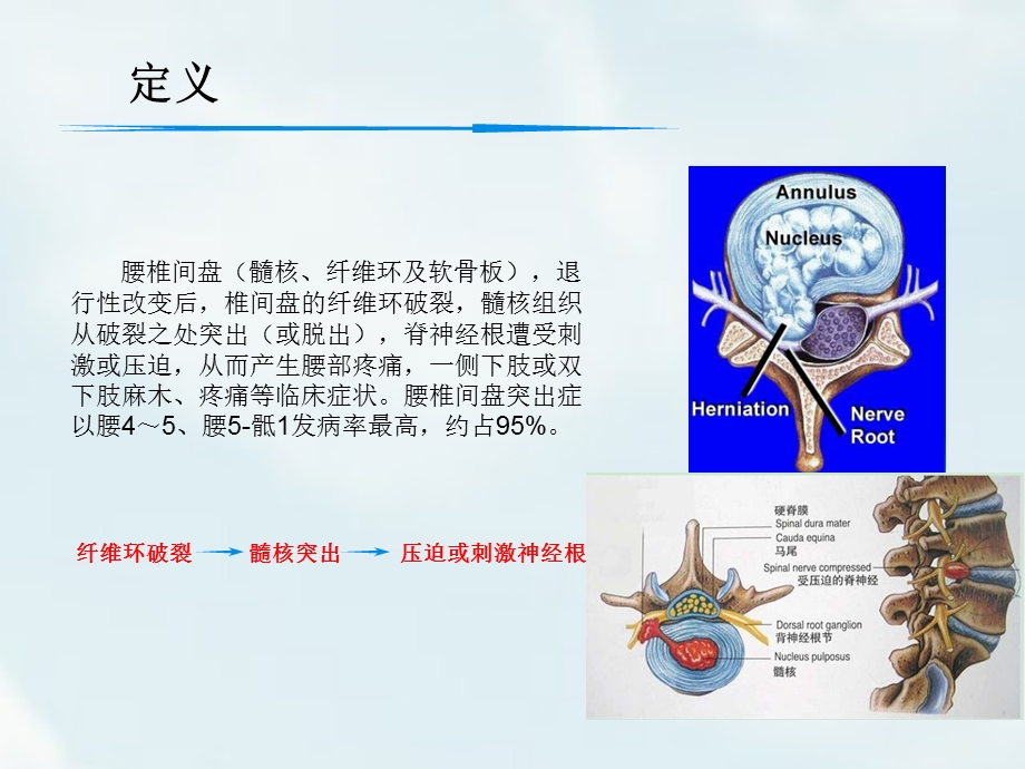 腰椎间盘突出的诊治ppt课件.ppt_第3页