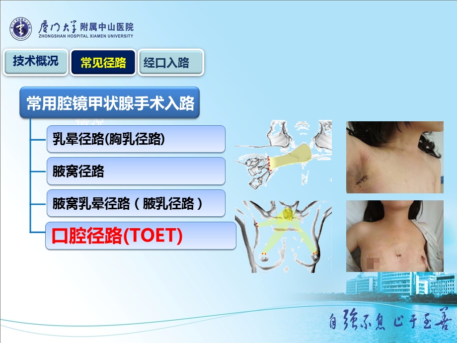 经口入路腔镜甲状腺切除术ppt课件.ppt_第2页