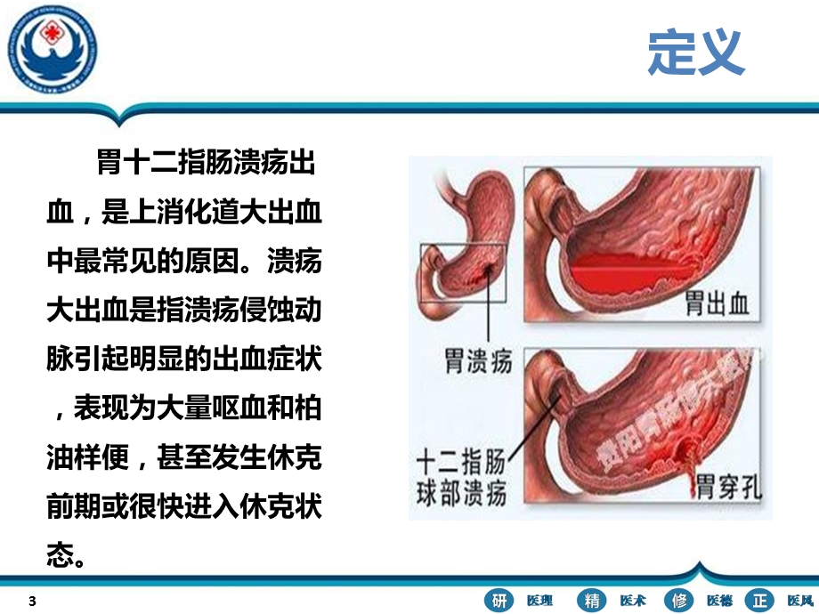 胃十二指肠溃疡大出血ppt课件.ppt_第3页